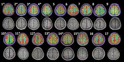 Superior Frontal Sulcus Focal Cortical Dysplasia Type II: An MRI, PET, and Quantified SEEG Study